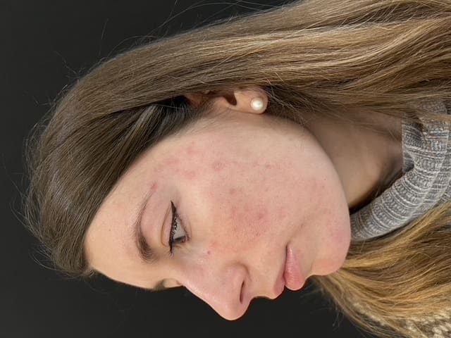 antonucci dermatology bologna acne removal