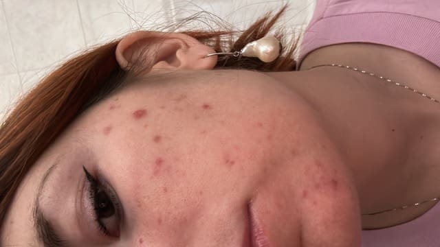 antonucci dermatology bologna acne removal