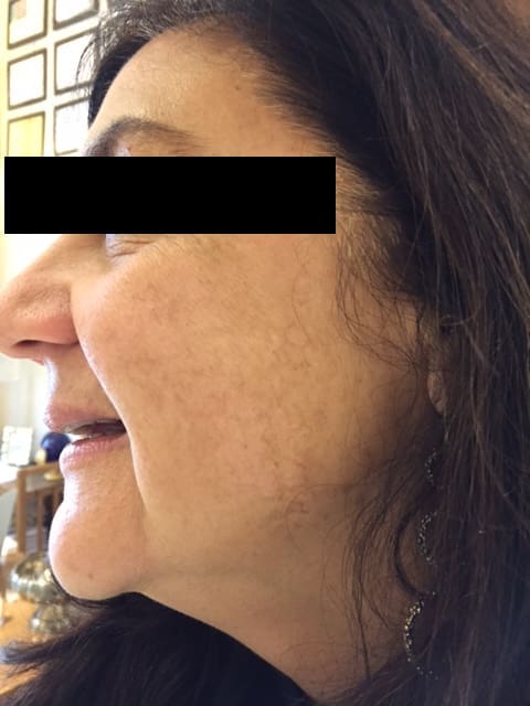 antonucci dermatology bologna facial blemish removal