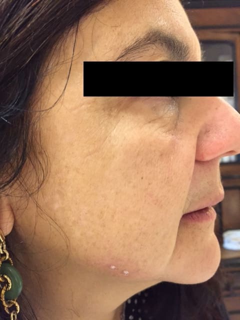 antonucci dermatology bologna facial blemish removal