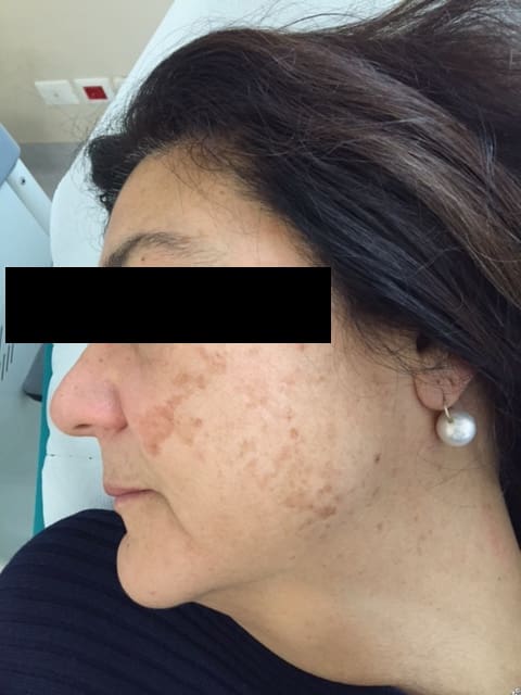 antonucci dermatology bologna facial blemish removal