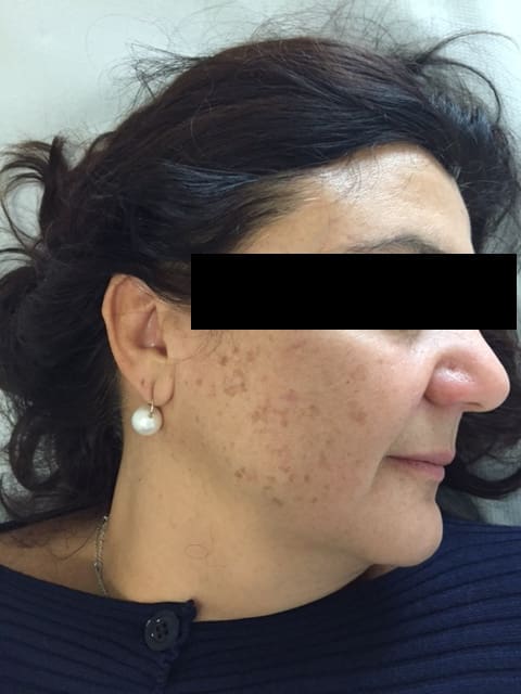 antonucci dermatology bologna facial blemish removal