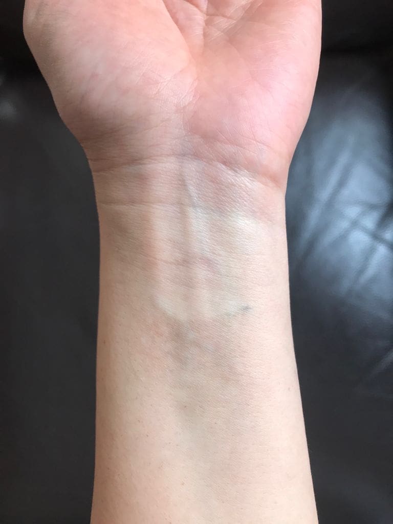 antonucci dermatology bologna tattoo removal after