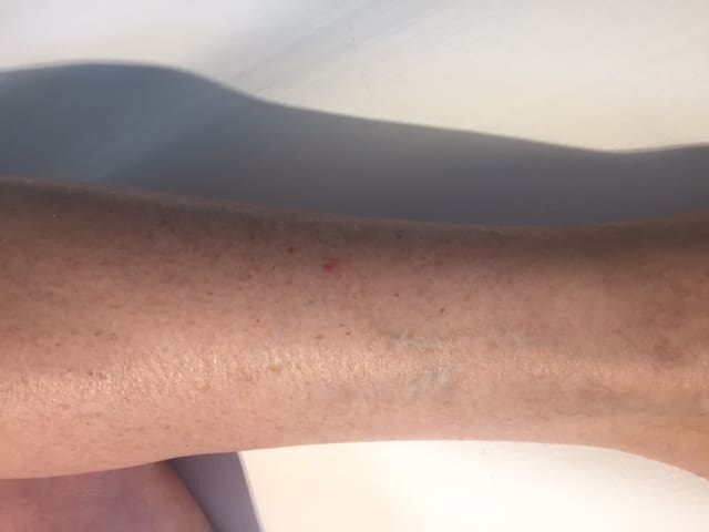 antonucci dermatology bologna tattoo removal after